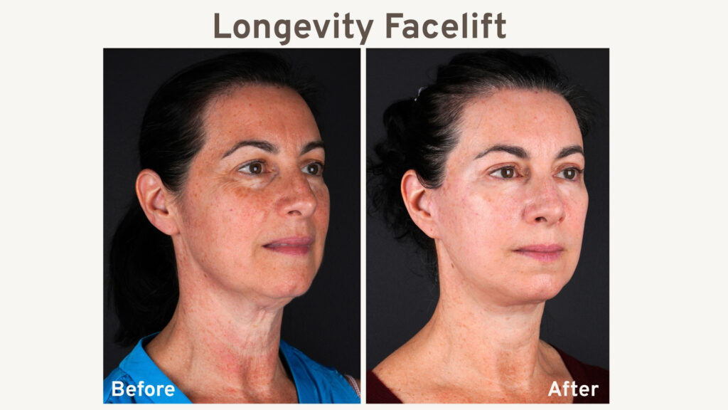 Before and after photos showing the difference between surface level lifting and a full three-dimensional reversal of facial aging.